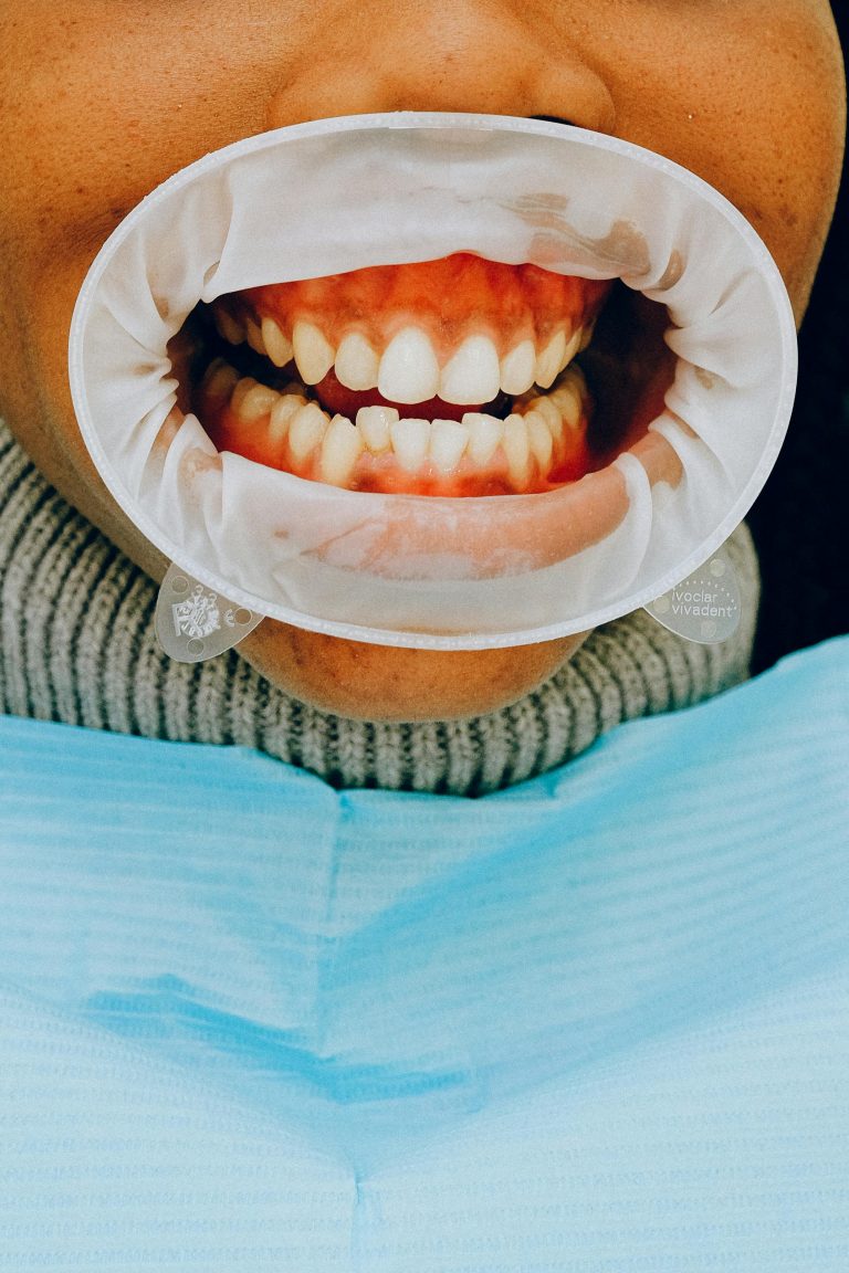 Bruxismo: ¿Como lo soluciona la odontología integrativa?
